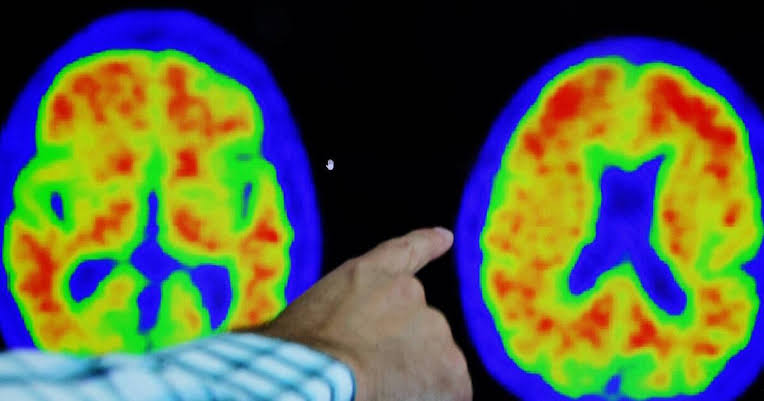 Estudo identifica proteína que acelera desenvolvimento do Alzheimer